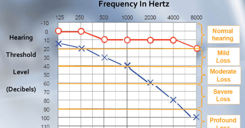 an audiogram chart